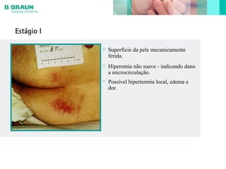 Estágio I
Hiperemia não suave - indicando dano
a microcirculação.
Superfície da pele mecanicamente
ferida.
Possível hipertermia local, edema e
dor.
 