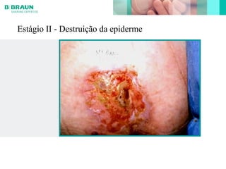 Estágio II - Destruição da epiderme
 
