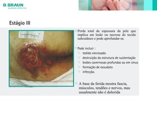 Estágio III
Perda total da espessura da pele que
implica em lesão ou necrose do tecido
subcutâneo e pode aprofundar-se.
Pode incluír :
 tedido necrosado
 destruição da estrutura de sustentação
 lesões cavernosas profundas ou em sinus
 formação de exsudato
 infecção.
A base da ferida mostra fascia,
músculos, tendões e nervos, mas
usualmente não é dolorida
 