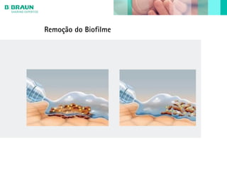 Remoção do Biofilme
 