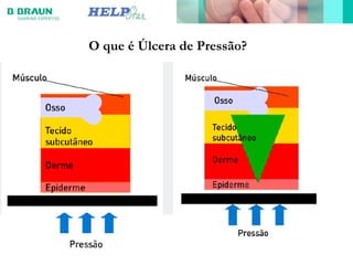 O que é Úlcera de Pressão?
 