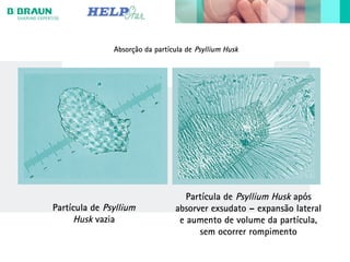 Absorção da partícula de Psyllium Husk
Partícula de Psyllium
Husk vazia
Partícula de Psyllium Husk após
absorver exsudato – expansão lateral
e aumento de volume da partícula,
sem ocorrer rompimento
 