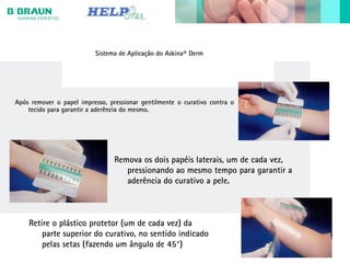 Sistema de Aplicação do Askina® Derm
Após remover o papel impresso, pressionar gentilmente o curativo contra o
tecido para garantir a aderência do mesmo.
Remova os dois papéis laterais, um de cada vez,
pressionando ao mesmo tempo para garantir a
aderência do curativo a pele.
Retire o plástico protetor (um de cada vez) da
parte superior do curativo, no sentido indicado
pelas setas (fazendo um ângulo de 45°)
 