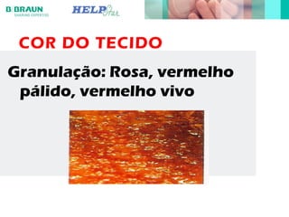 COR DO TECIDO
Granulação: Rosa, vermelho
pálido, vermelho vivo
 