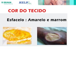 COR DO TECIDO
Esfacelo : Amarelo e marrom
 