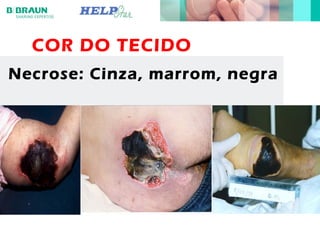 COR DO TECIDO
Necrose: Cinza, marrom, negra
 