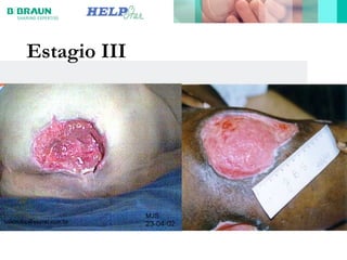 Estagio III
 