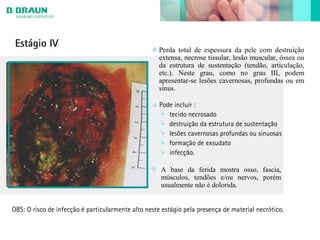 Estágio IV
Perda total de espessura da pele com destruição
extensa, necrose tissular, lesão muscular, óssea ou
da estrutura de sustentação (tendão, articulação,
etc.). Neste grau, como no grau III, podem
apresentar-se lesões cavernosas, profundas ou em
sinus.
A base da ferida mostra osso, fascia,
músculos, tendões e/ou nervos, porém
usualmente não é dolorida.
OBS: O risco de infecção é particularmente alto neste estágio pela presença de material necrótico.
Pode incluír :
 tecido necrosado
 destruição da estrutura de sustentação
 lesões cavernosas profundas ou sinuosas
 formação de exsudato
 infecção.
 
