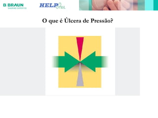 O que é Úlcera de Pressão?
 