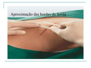 Aproximação das bordas da ferida
 