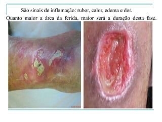 São sinais de inflamação: rubor, calor, edema e dor.
Quanto maior a área da ferida, maior será a duração desta fase.
 
