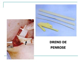 DRENO DE
PENROSE
 
