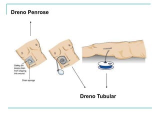 Dreno Penrose
Dreno Tubular
 