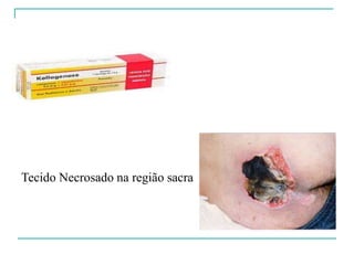 Tecido Necrosado na região sacra
 