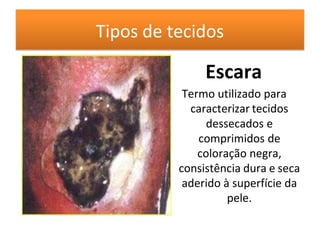 Tipos de tecidos
Escara
Termo utilizado para
caracterizar tecidos
dessecados e
comprimidos de
coloração negra,
consistência dura e seca
aderido à superfície da
pele.
 