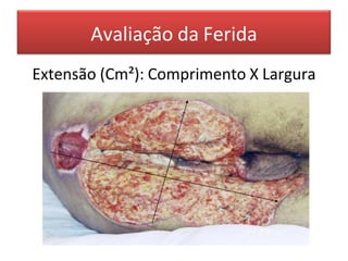 Avaliação da Ferida
Extensão (Cm²): Comprimento X Largura
 