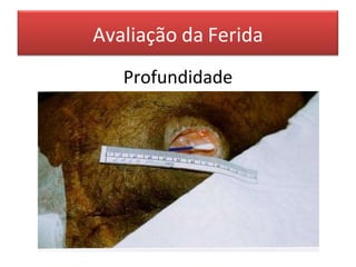 Avaliação da Ferida
Profundidade
 