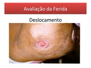 Avaliação da Ferida
Deslocamento
 