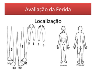 Avaliação da Ferida
Localização
 