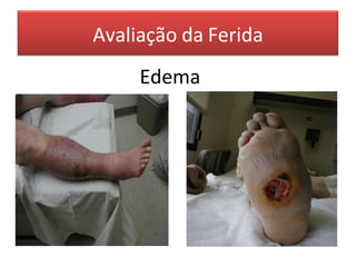 Avaliação da Ferida
Edema
 