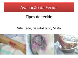 Avaliação da Ferida
Tipos de tecido
Vitalizado, Desvitalizado, Misto
 