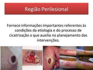 Região Perilesional
Fornece informações importantes referentes às
condições da etiologia e do processo de
cicatrização o que auxilia no planejamento das
intervenções.
 