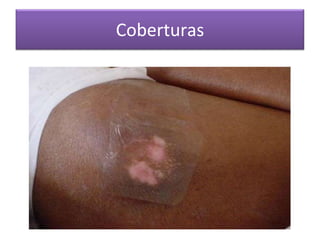 Coberturas
 