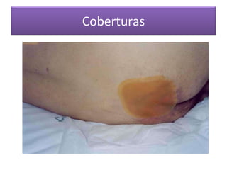 Coberturas
 