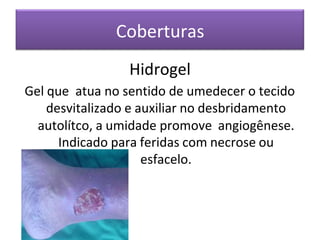 Coberturas
Hidrogel
Gel que atua no sentido de umedecer o tecido
desvitalizado e auxiliar no desbridamento
autolítco, a umidade promove angiogênese.
Indicado para feridas com necrose ou
esfacelo.
 