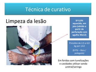 Técnica de curativo
Pressões de 2,5 a 4,0
kg por cm2
(8 PSI – libra /
polegada)
Limpeza da lesão
Em feridas com tunelizações
e cavidades utilizar sonda
uretral/seringa
SF 0,9%
aquecido, em
jato (obtido a
partir de
perfuração com
agulha 40x12)
 
