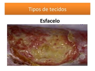 Tipos de tecidos
Esfacelo
 