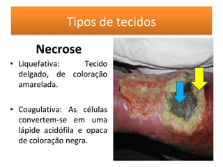 Tipos de tecidos
Necrose
• Liquefativa: Tecido
delgado, de coloração
amarelada.
• Coagulativa: As células
convertem-se em uma
lápide acidófila e opaca
de coloração negra.
 