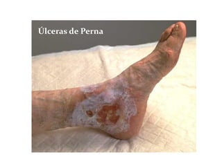 Úlceras de Perna
 