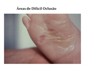 Áreas de Difícil Oclusão
 