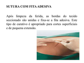 SUTURA COM FITAADESIVA
Após limpeza da ferida, as bordas do tecido
seccionado são unidas e fixa-se a fita adesiva. Este
tipo de curativo é apropriado para cortes superficiais
e de pequena extensão.
 