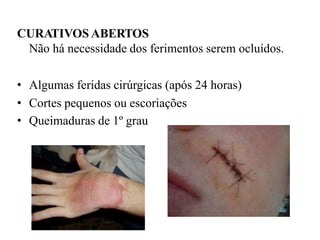 CURATIVOS ABERTOS
Não há necessidade dos ferimentos serem ocluídos.
• Algumas feridas cirúrgicas (após 24 horas)
• Cortes pequenos ou escoriações
• Queimaduras de 1º grau
 