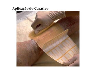 Aplicação do Curativo
 