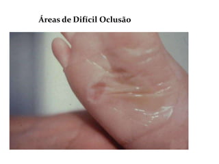 Áreas de Difícil Oclusão
 