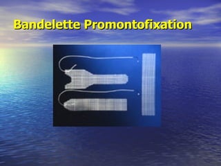 Bandelette Promontofixation 
