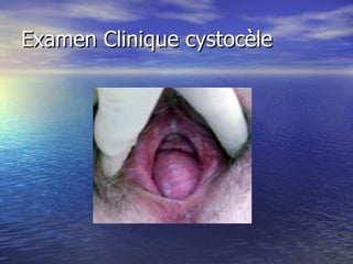 Examen Clinique cystocèle 