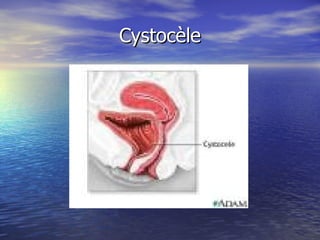 Cystocèle 