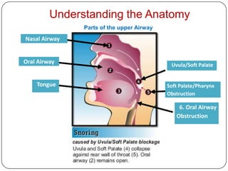 Understanding the Anatomy
               Parts of the upper Airway
Nasal Airway


Oral Airway                                 Uvula/Soft Palate


    Tongue                                 Soft Palate/Pharynx
                                           Obstruction

                                               6. Oral Airway
                                              Obstruction
 