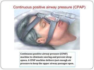 Continuous positive airway pressure (CPAP)




    Continuous positive airway pressure (CPAP)
    machine to eliminate snoring and prevent sleep
    apnea. A CPAP machine delivers just enough air
    pressure to keep the upper airway passages open.
 