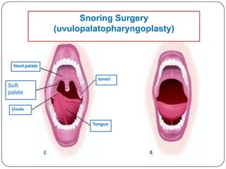 Snoring Surgery
                (uvulopalatopharyngoplasty)



  Hard palate

                          tonsil
Soft                      ring
palate

 Uvula


                        Tongue
 