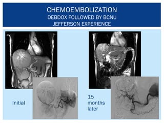 Liver Directed Therapy - Marlana Orloff, MD | PPT