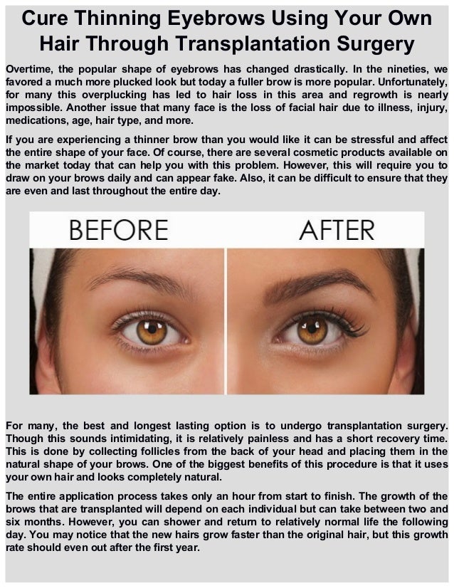 Cure Thinning Eyebrows Using Your Own Hair Through Transplantation Su