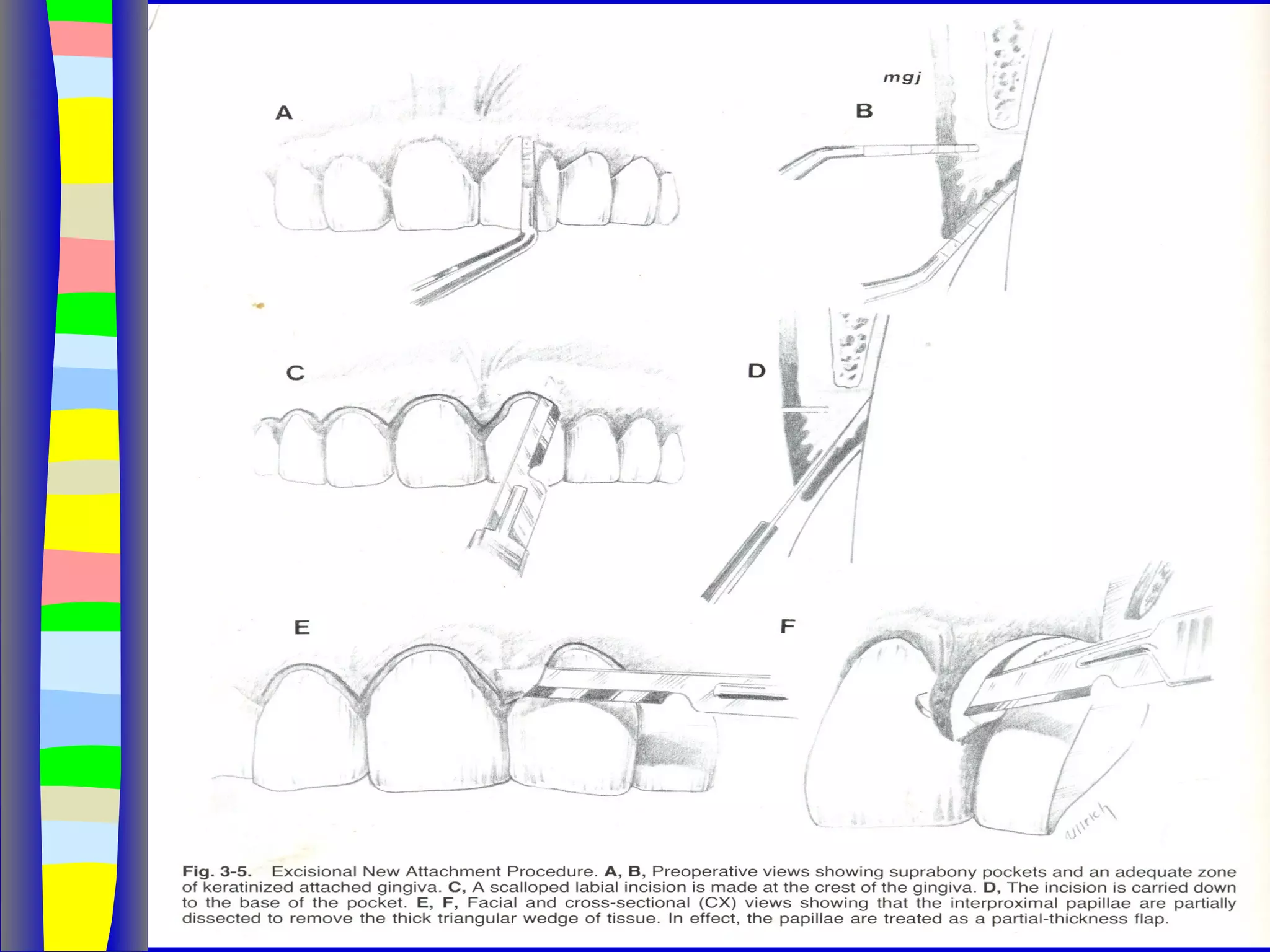 Curettage, gingivectomy & gingivoplasty PPT