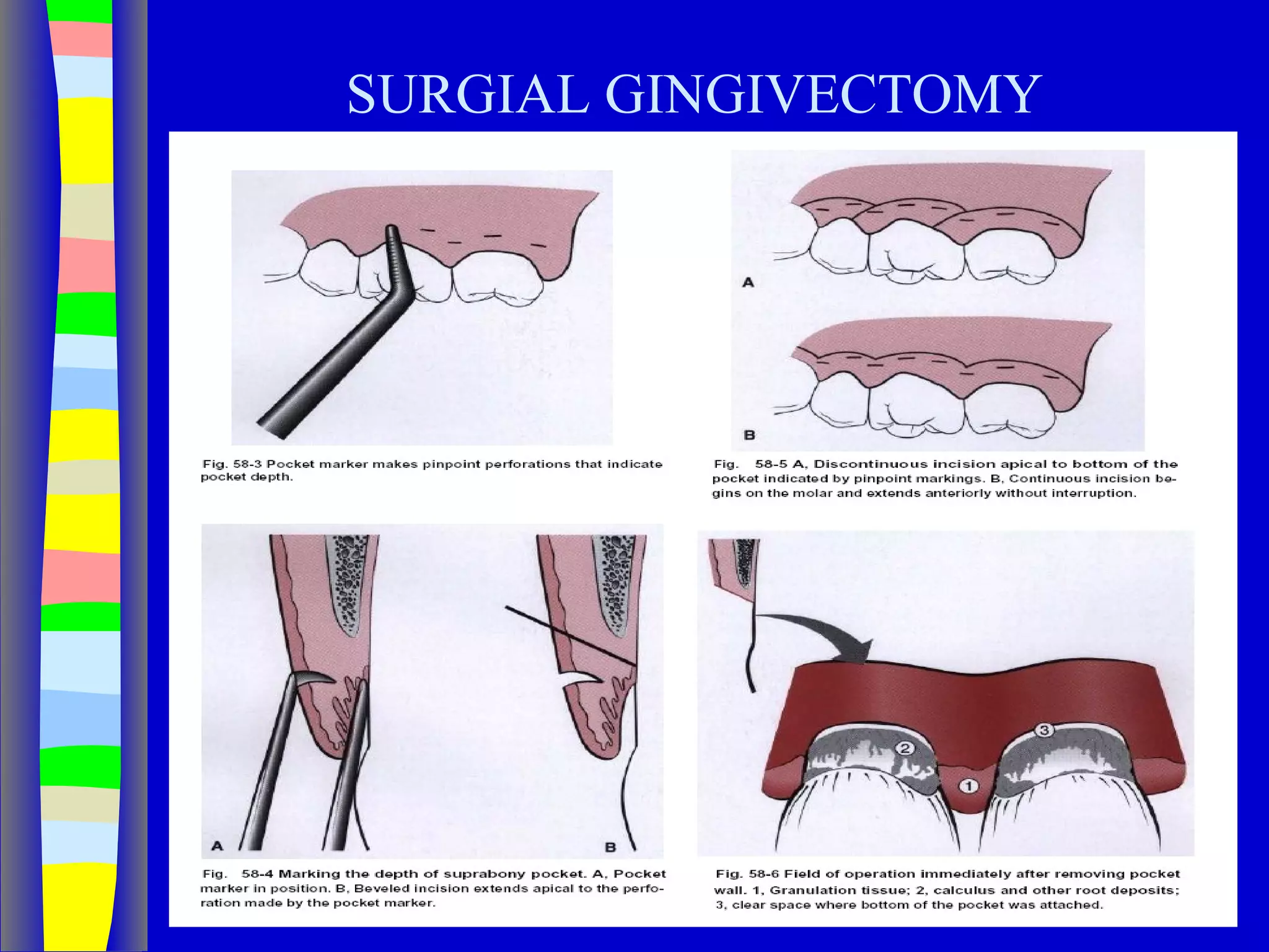 Curettage, gingivectomy & gingivoplasty PPT