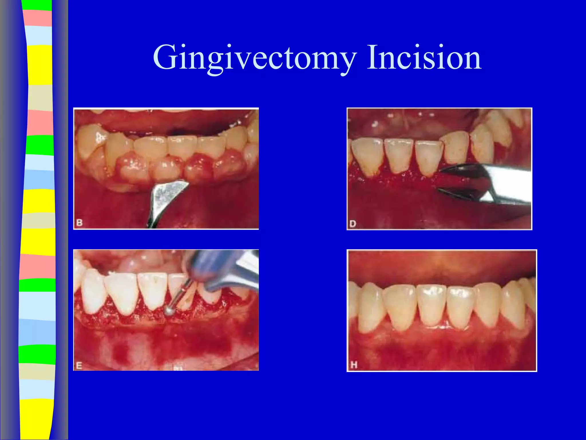 Curettage, gingivectomy & gingivoplasty PPT