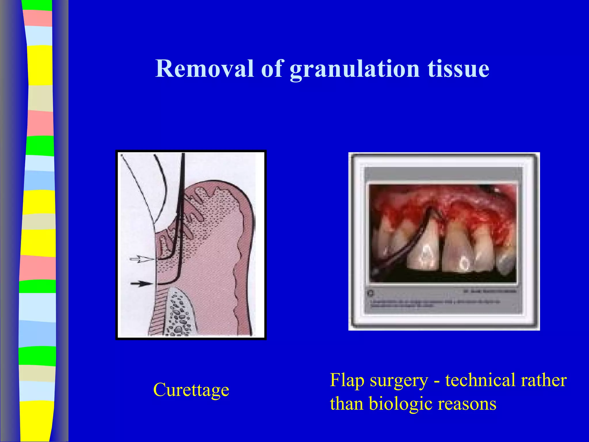 Curettage, gingivectomy & gingivoplasty PPT